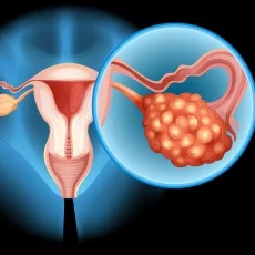 Imagen informativa sobre Cáncer de ovario