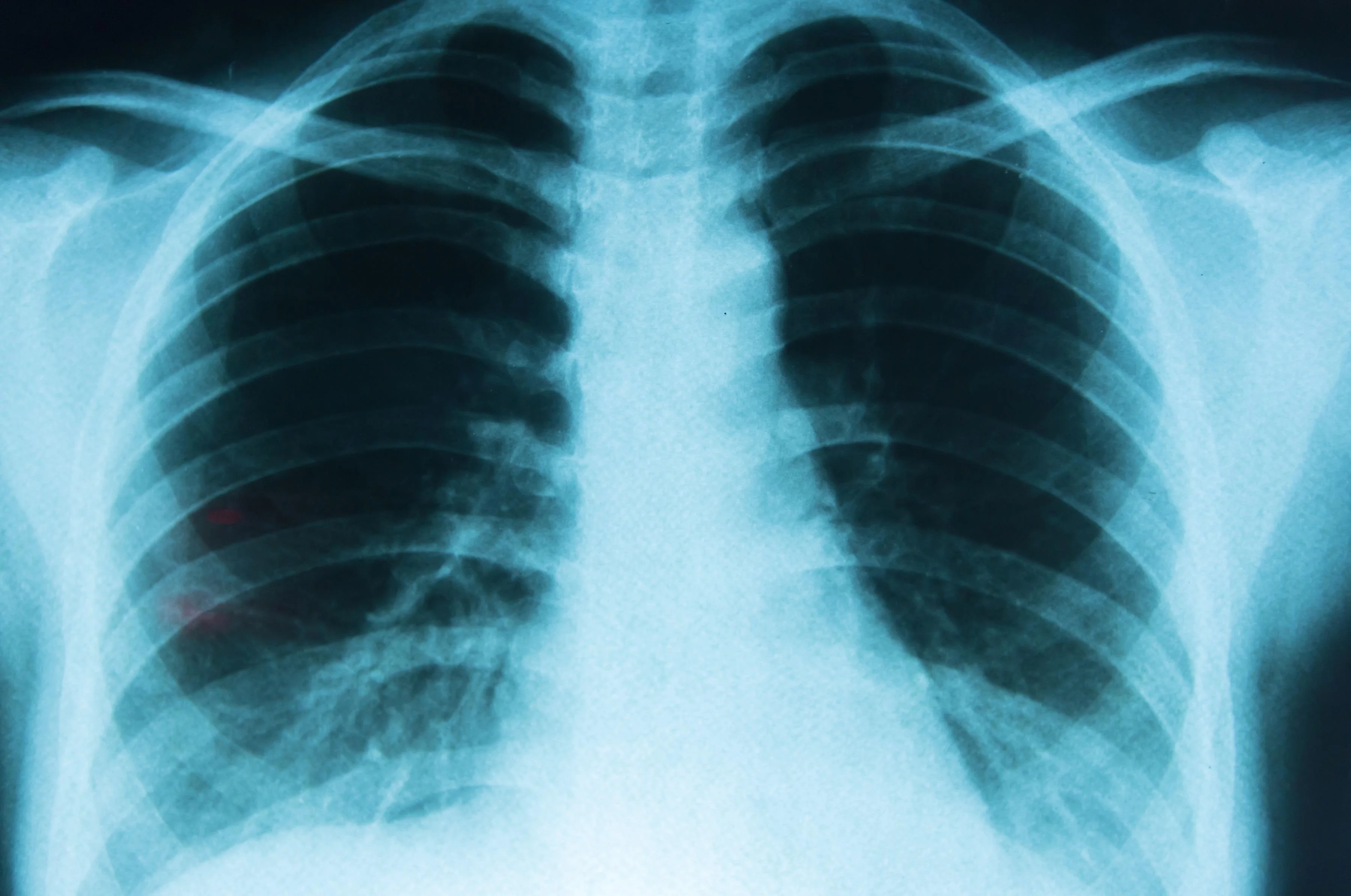 Imagen informativa sobre Cáncer de pulmón