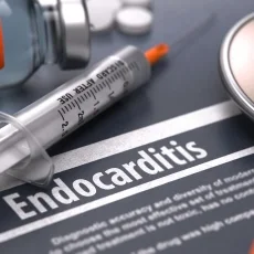Imagen informativa sobre Endocarditis