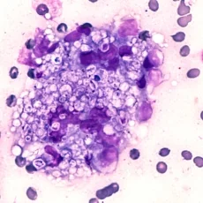 Imagen informativa sobre Histoplasmosis