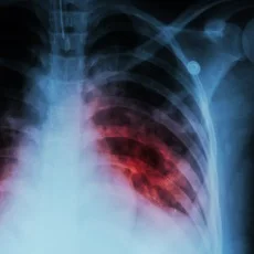 Imagen informativa sobre Tuberculosis